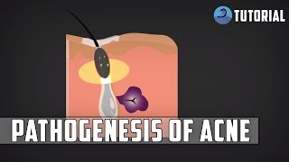 Acne Pathophysiology  Acne Vulgaris Pimples Pathogenesis [upl. by Asirral198]