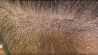 SCALP PSORIASIS FLAKING ALLOVER [upl. by Pisano]