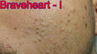 Extraction for Teenage Acne  Part 1 of 3 [upl. by Hannah]