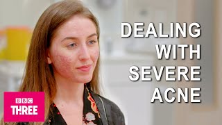 Dealing With Severe Acne Skin [upl. by Asille]