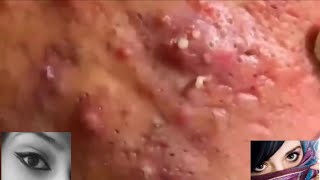 Severe Cystic Acne Infection Treatment Young Age [upl. by Aihseyn]