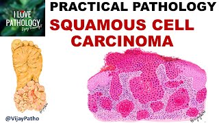 SQUAMOUS CELL CARCINOMA Clinical features amp Morphology Premalignant lesions [upl. by Jim819]