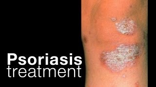 Picking Psoriasis Plaques amp Lifting Dermatitis Scales Pt 2 [upl. by Dogs]