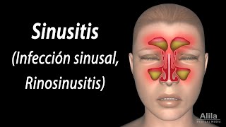 Sinusitis Animación Alila Medical Media Español [upl. by Morril862]