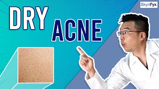 How To Treat Dry Skin  Acne Dry Acne  5 Tips To Follow [upl. by Roberson]