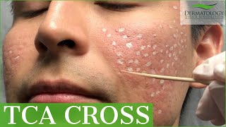 Acne Scar Removal with TCA Cross 80  Los Angeles  Dr Ben Behnam [upl. by Eblehs]