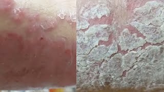 EXTREME REGENERATION 1 WEEK AFTER FULL CLEANING Psoriasis [upl. by Nickelsen]