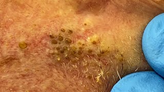 Extremely Clogged Pores Extracted  Contour Dermatology [upl. by Kimbell382]