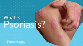 What Is Psoriasis [upl. by Meece180]