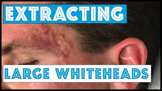 Acne Vulgaris and Extracting large Whiteheads  Part 1 [upl. by Retsub]