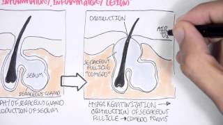 Acne Pathophsyiology [upl. by Annayar]