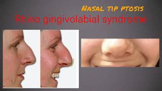 Nasal tip lift and nasal flare correction by botox [upl. by Fidelity]