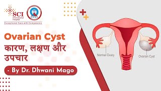 Ovarian Cyst कारण लक्षण और उपचार  Dr Dhwani Mago  SCI Hospital [upl. by Maximilianus]