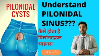 Pilonidal Sinus in Hindi  Pilonidal Sinus Treatment [upl. by Elleirda]