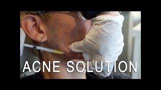 Cystic Acne Solution Kenalog Injection [upl. by Sinylg]