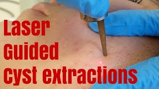 Extracting blind blackheads with lasers [upl. by Ahsiemaj]