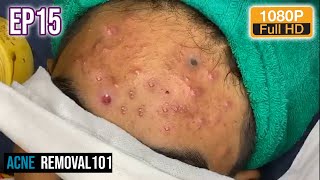 Cystic Acne Extraction 20mn  Acne treatment by ACNEREMOVAL101 [upl. by Llemor78]