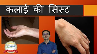 कलाईकीसिस्ट Wrist Ganglion Cyst Hindi [upl. by Anavrin]