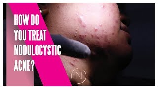 How Do You Treat Nodulocystic Acne  Houston Dermatology [upl. by Melamed]