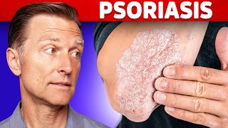 Psoriasis Scalp Scratching Huge Flakes 718 [upl. by Colombi]