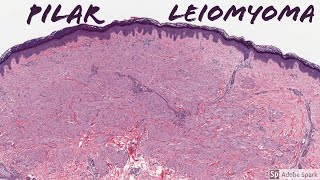 Leiomyoma Pilar Type Piloleiomyoma 5Minute Pathology Pearls [upl. by Collayer]