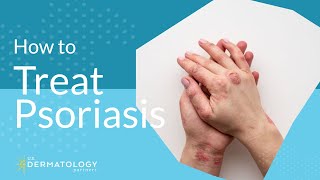 Psoriasis Treatment  Explained by Dermatologist [upl. by Arekat]