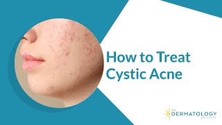 How to Treat Cystic Acne [upl. by Zinck]