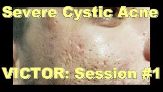 Severe Cystic Acne  Victor Session 1 [upl. by Durtschi]