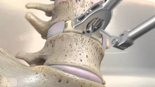 STALIF M™ MIDLINE II Surgical Technique Animation  Anterior Lumbar Interbody Fusion [upl. by Hadwin225]