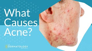 What Causes Acne  Explained by Dermatologist [upl. by Elnar]