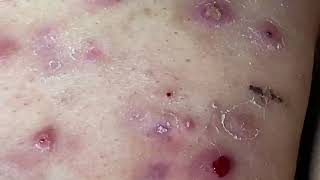 Cystic Acne Cysts Acne Dermatology Comedones and Whiteheads [upl. by Attenod142]