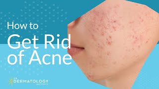 Acne Treatment  Explained by Dermatologist [upl. by Tynan]