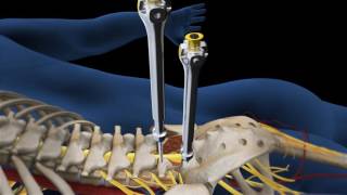 Lumbar Fusion of L5 S1 Animation [upl. by Kathlin]