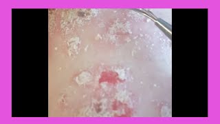 Plaque Psoriasis Removal  How to remove psoriasis [upl. by Dalohcin]