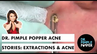 Dr Pimple Popper Acne Stories Extractions amp Acne [upl. by Orvie965]