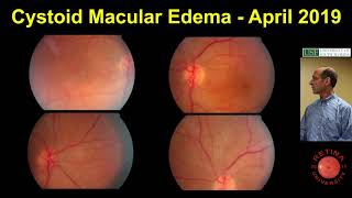 Cystoid Macular Edema [upl. by Nylrak]